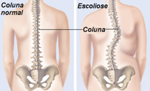 escoliose-causas-sintomas-tratamento